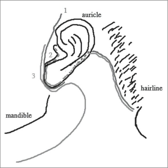 Intra-auricular modification of facelift incision decreased the risk of Frey syndrome.