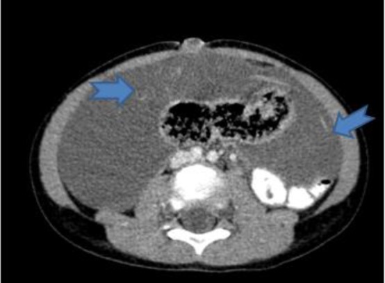 A Case Report of a Huge Mesenteric Cyst in a 5-Year-Old Girl: A Rare and Challenging Finding in Radiological Assessment.