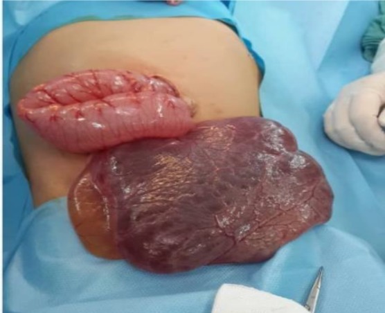 A Case Report of a Huge Mesenteric Cyst in a 5-Year-Old Girl: A Rare and Challenging Finding in Radiological Assessment.