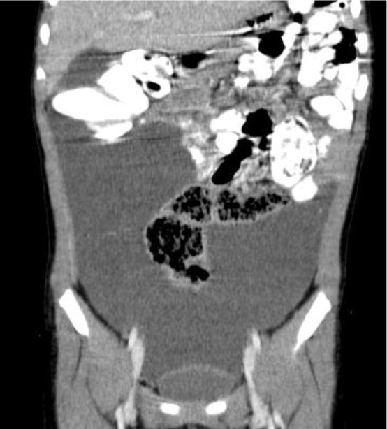 A Case Report of a Huge Mesenteric Cyst in a 5-Year-Old Girl: A Rare and Challenging Finding in Radiological Assessment.