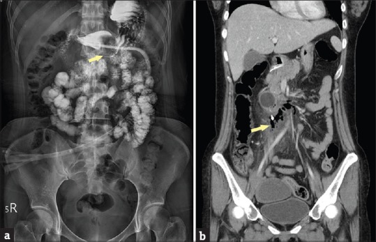 Duodenal perforation after gastrostomy tube replacement: Case report and literature review.