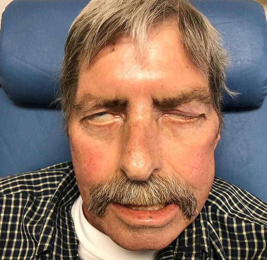 Look granulomatosis with polyangiitis (GPA) straight in the face: missed opportunities leading to a delayed diagnosis.