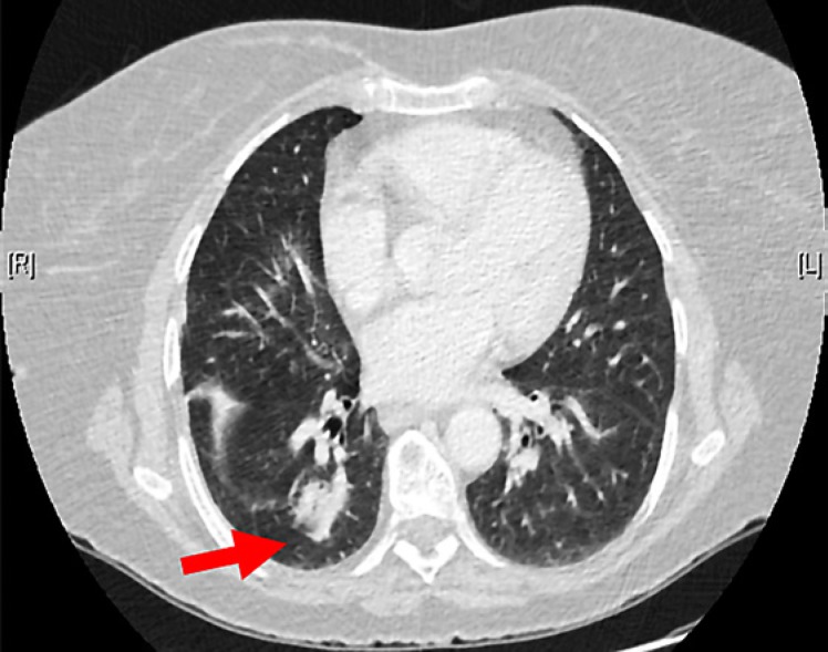 Primary Pulmonary MALT Lymphoma: A Case Report and Literature Review.