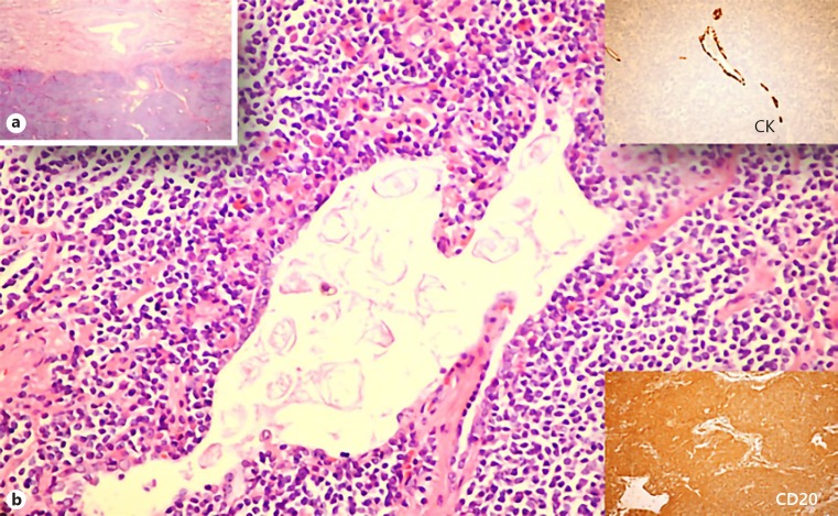 Primary Pulmonary MALT Lymphoma: A Case Report and Literature Review.