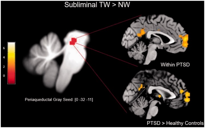 The Threatful Self: Midbrain Functional Connectivity to Cortical Midline and Parietal Regions During Subliminal Trauma-Related Processing in PTSD.