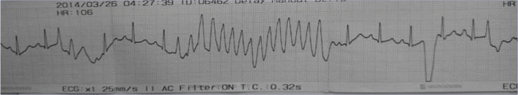 Electrical Storm in the Absence of a Structural Heart Disease in a Young Girl.