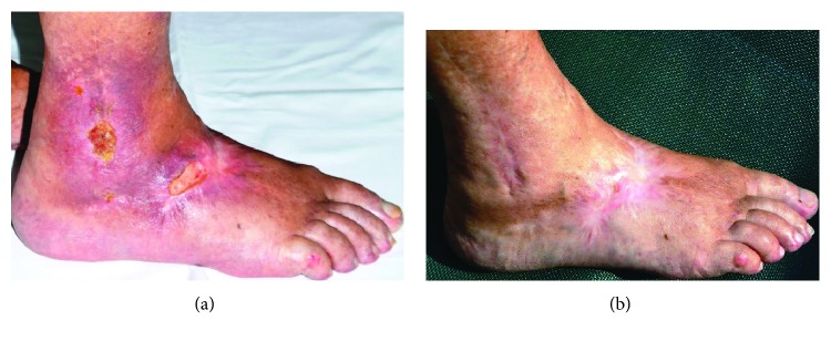 Plasma Medicine: Applications of Cold Atmospheric Pressure Plasma in Dermatology.