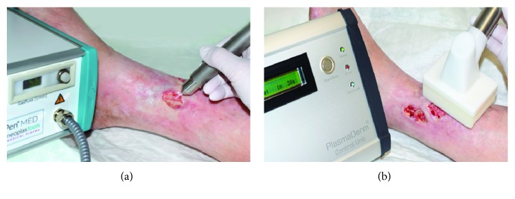 Plasma Medicine: Applications of Cold Atmospheric Pressure Plasma in Dermatology.