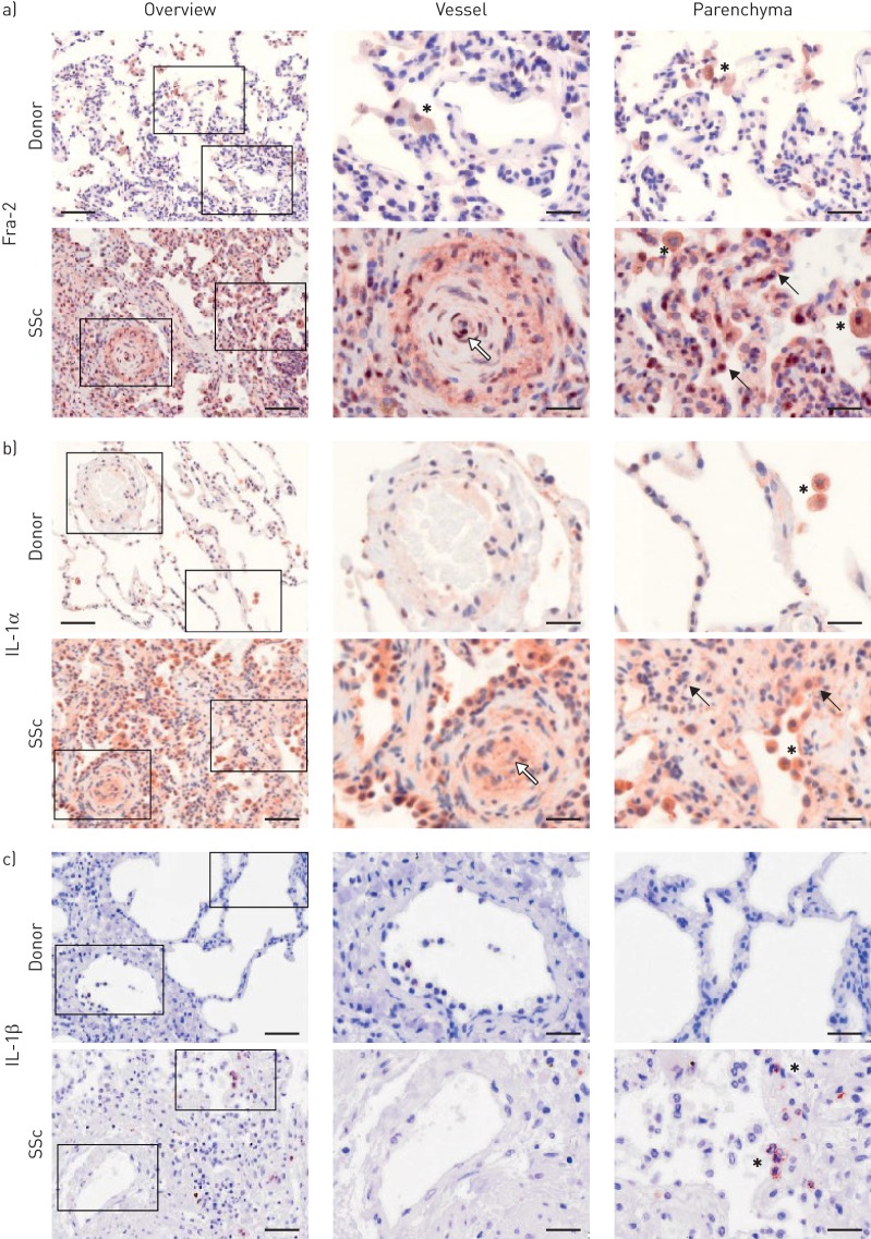 IL-1 receptor blockade skews inflammation towards Th2 in a mouse model of systemic sclerosis.