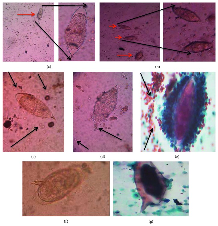 Cytological and Wet Mount Microscopic Observations Made in Urine of <i>Schistosoma haematobium</i>-Infected Children: Hint of the Implication in Bladder Cancer.