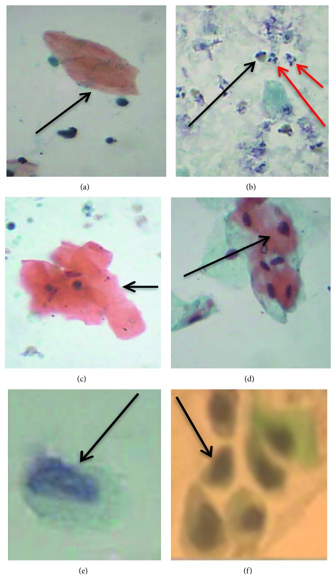 Cytological and Wet Mount Microscopic Observations Made in Urine of <i>Schistosoma haematobium</i>-Infected Children: Hint of the Implication in Bladder Cancer.