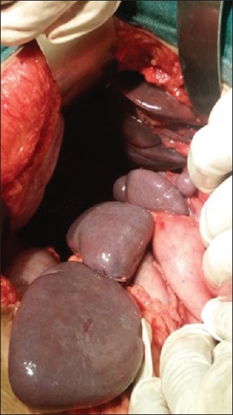 Situs Ambiguous Anomaly during Laparoscopic Cholecystectomy in an Adult Female.