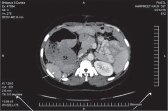 Situs Ambiguous Anomaly during Laparoscopic Cholecystectomy in an Adult Female.