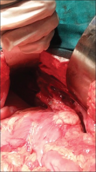 Situs Ambiguous Anomaly during Laparoscopic Cholecystectomy in an Adult Female.
