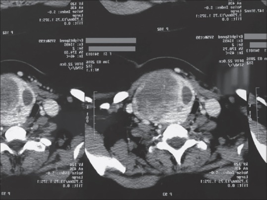 "Tracheomalacia after Thyroidectomy," Does it Truly Exist?