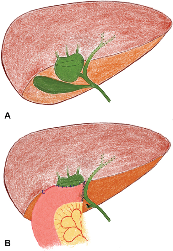 When It Doesn't Fit: Congenital Anomalies of the Choledochus.