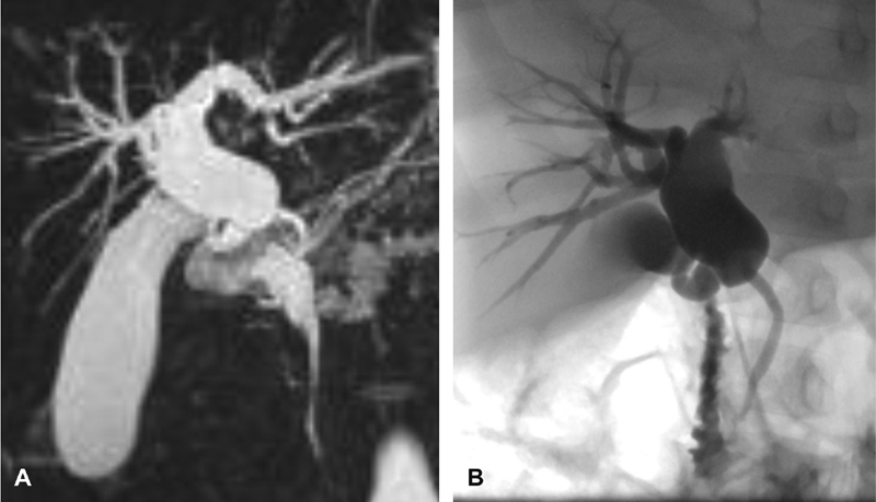 When It Doesn't Fit: Congenital Anomalies of the Choledochus.