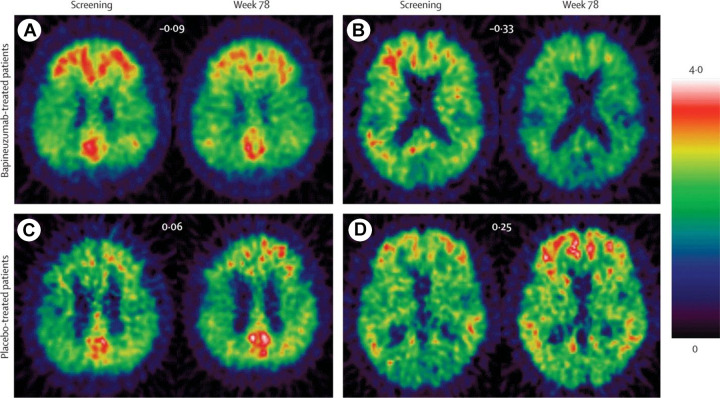 Radionuclide Imaging for Neuroscience: Current Opinion and Future Directions.