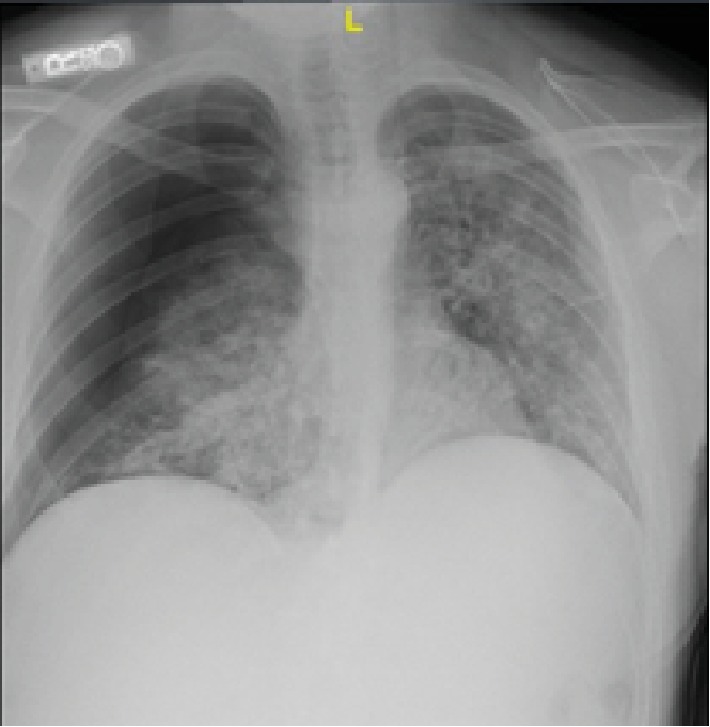 A Case Series of Vaping-Induced Lung Injury in a Community Hospital Setting.