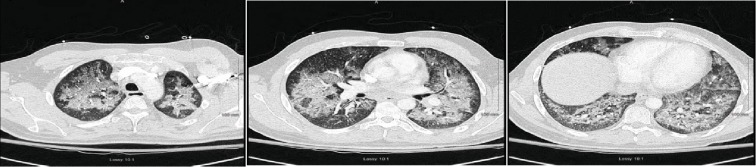 A Case Series of Vaping-Induced Lung Injury in a Community Hospital Setting.