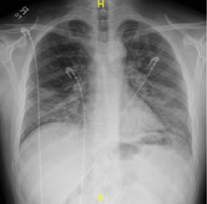 A Case Series of Vaping-Induced Lung Injury in a Community Hospital Setting.