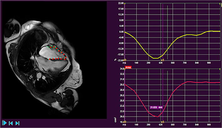 Cardiac Magnetic Resonance in Pulmonary Hypertension-an Update.