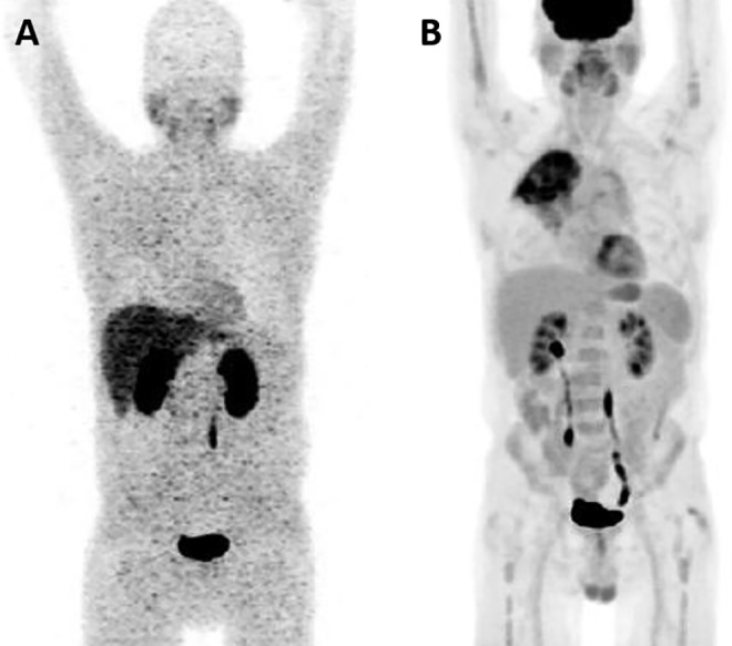 Evaluation of Musculoskeletal and Pulmonary Bacterial Infections With [<sup>124</sup>I]FIAU PET/CT.