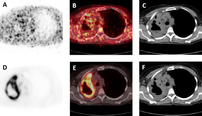 Evaluation of Musculoskeletal and Pulmonary Bacterial Infections With [<sup>124</sup>I]FIAU PET/CT.