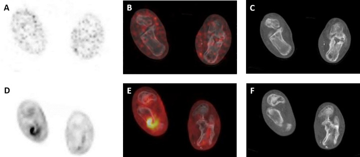 Evaluation of Musculoskeletal and Pulmonary Bacterial Infections With [<sup>124</sup>I]FIAU PET/CT.