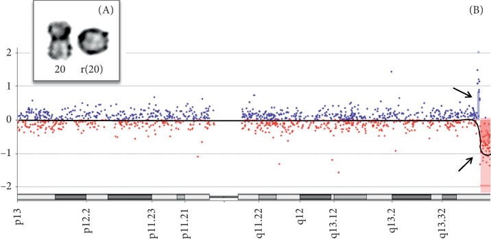 Candidate Genes Associated with Delayed Neuropsychomotor Development and Seizures in a Patient with Ring Chromosome 20.