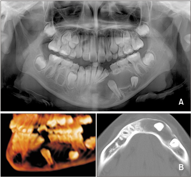 Comprehensive orthodontic treatment of a young girl with an odontogenic keratocyst and impacted teeth in the mandible.