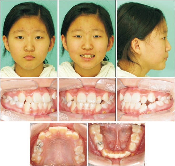 Comprehensive orthodontic treatment of a young girl with an odontogenic keratocyst and impacted teeth in the mandible.