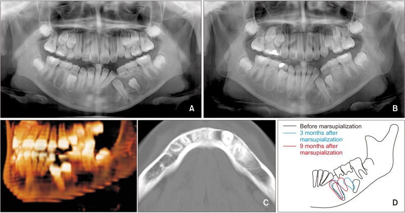 Comprehensive orthodontic treatment of a young girl with an odontogenic keratocyst and impacted teeth in the mandible.