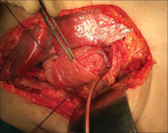 Binding Pancreaticojejunostomy: Is It Safe?