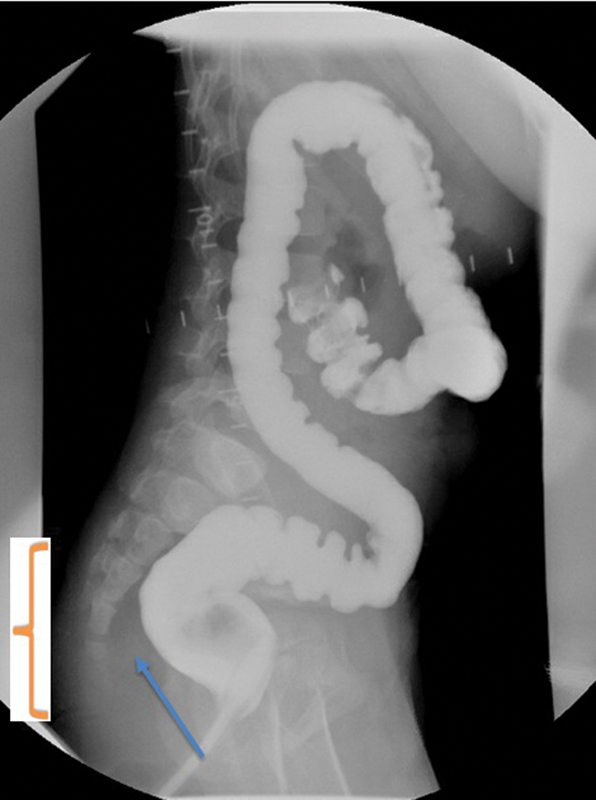 A Hirschsprung Pull-through, "with a Twist".