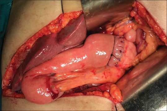 Binding Pancreaticojejunostomy: Is It Safe?
