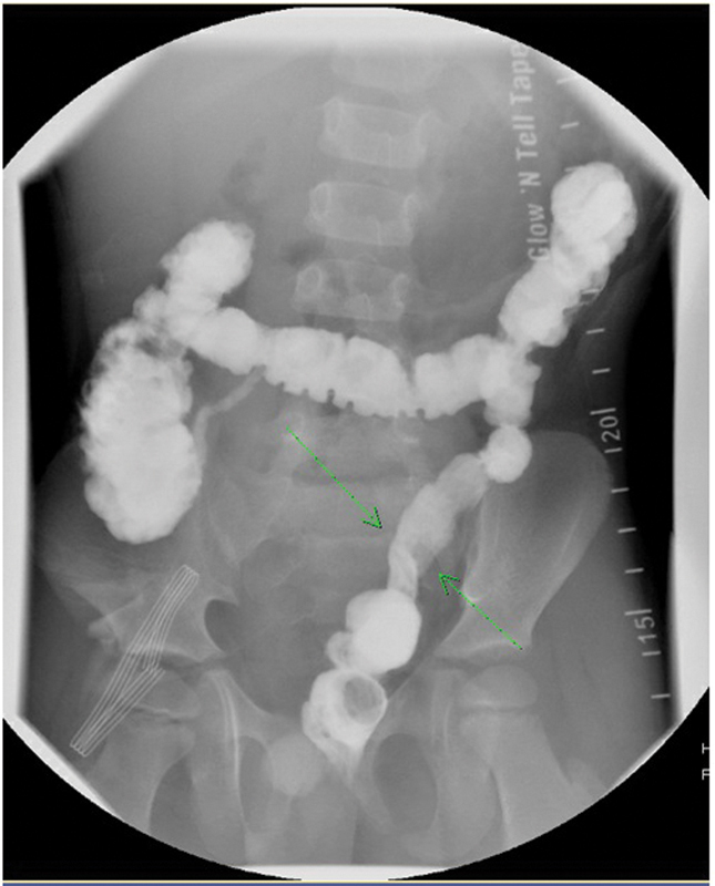 A Hirschsprung Pull-through, "with a Twist".