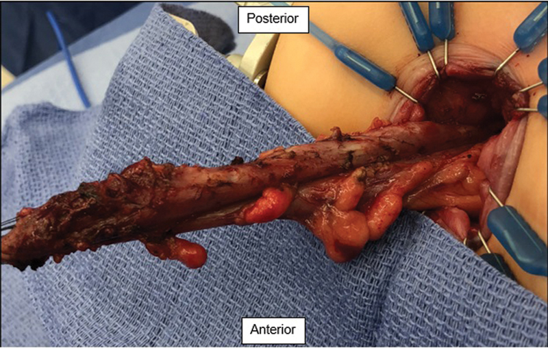 A Hirschsprung Pull-through, "with a Twist".