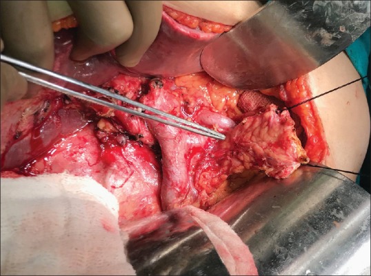 Binding Pancreaticojejunostomy: Is It Safe?