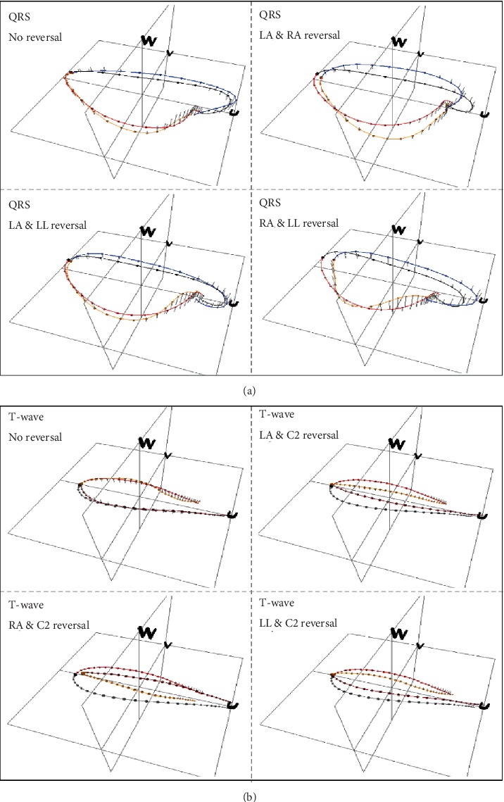 False Alarm Reduction in Self-Care by Personalized Automatic Detection of ECG Electrode Cable Interchanges.