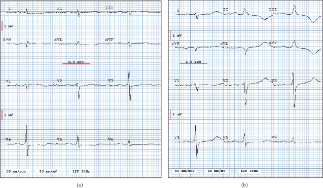 False Alarm Reduction in Self-Care by Personalized Automatic Detection of ECG Electrode Cable Interchanges.