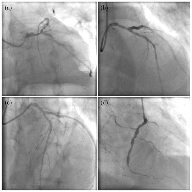 Inter-observer variation of Syntax score among cardiac surgeons, clinical and interventional cardiologists.