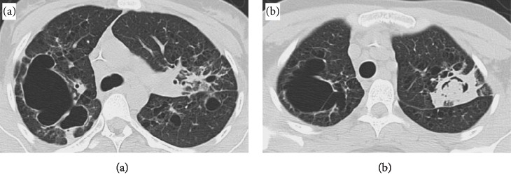 Aspergilloma Superimposed Infection on Lymphoid Interstitial Pneumonia.