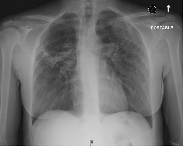 Aspergilloma Superimposed Infection on Lymphoid Interstitial Pneumonia.