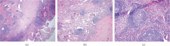 Aspergilloma Superimposed Infection on Lymphoid Interstitial Pneumonia.