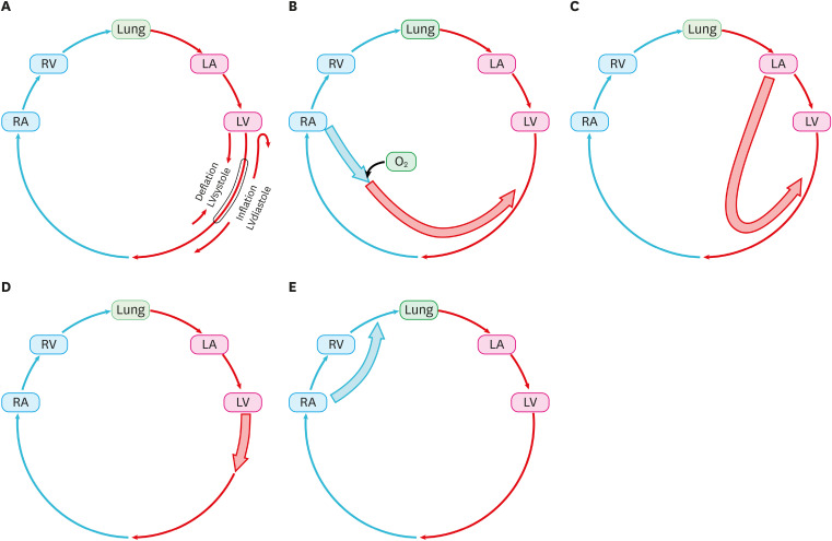 Mechanical Circulatory Support for Acute Heart Failure Complicated by Cardiogenic Shock.