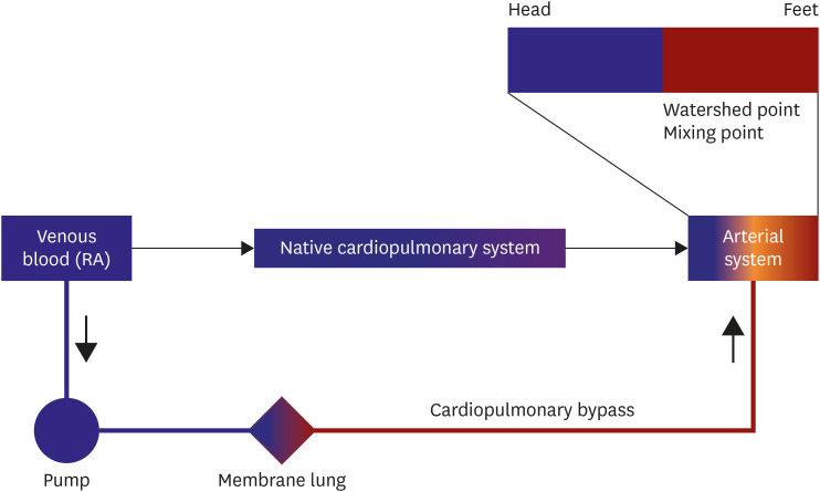 Mechanical Circulatory Support for Acute Heart Failure Complicated by Cardiogenic Shock.