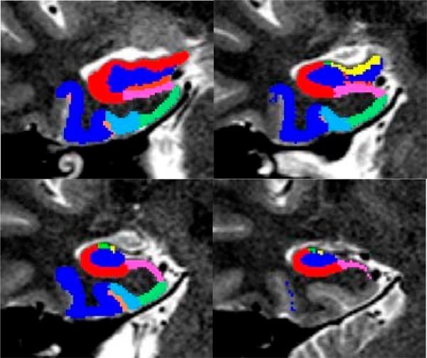 Grant Report on the Effects of Childhood Maltreatment on Neurocircuitry in Adolescent Depression.