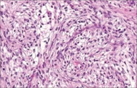 Pemphigus in Sarcomatoid Renal Cell Carcinoma: A Rare Paraneoplastic Manifestation.