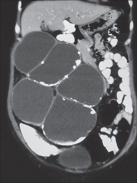 Pemphigus in Sarcomatoid Renal Cell Carcinoma: A Rare Paraneoplastic Manifestation.